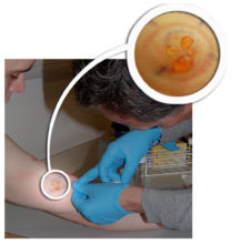 Allergic skin reaction