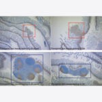 Images depicting sections of the intestine of the transgenic APC mouse model used in this study. Examples of intestine from a transgenic APC mouse (left), an APC mouse that lacks IL-25 (middle), and an APC mouse that lacks ILC2s (right). Individual dots indicate the nuclei of different cells. Brown nuclei indicate those cells (immune cells, epithelial cells or cancerous cells) that are actively proliferating. Nuclei of cells not proliferating are observed in blue. Images on the upper row depict examples of intestinal cancerous tissue (red squares). It can be observed that the cancers from the transgenic APC mouse (left) are larger than those found in the APC mice that lack IL-25 (middle) or ILC2s (right). Images on the lower row show lymphoid tissue containing immune cells (blue squares) present in the intestine. The transgenic APC mouse presents reduced lymphoid tissue. In contrast, APC mice without an IL-25 signal or ILC2s develop larger lymphoid tissue with actively proliferating immune cells, indicating a more active immune response.